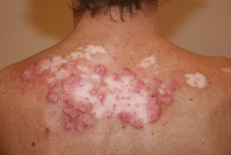 Tế bào gốc trung mô từ dây rốn: Nguồn gốc, ưu điểm và ứng dụng 3