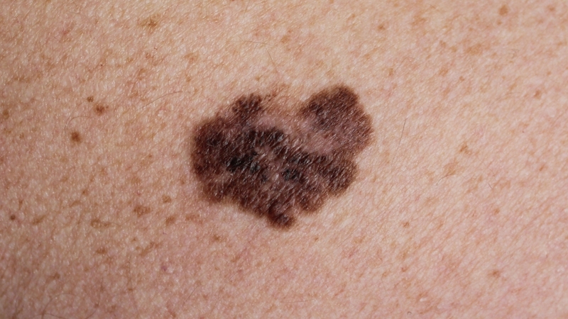 Ung thư sắc tố (melanoma) phát sinh từ tế bào tạo sắc tố da