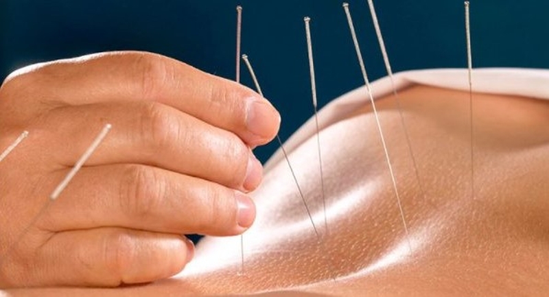 Châm cứu huyệt quyết âm nhu cần thực hiện bởi chuyên gia hoặc bác sĩ có tay nghề để tránh rủi ro