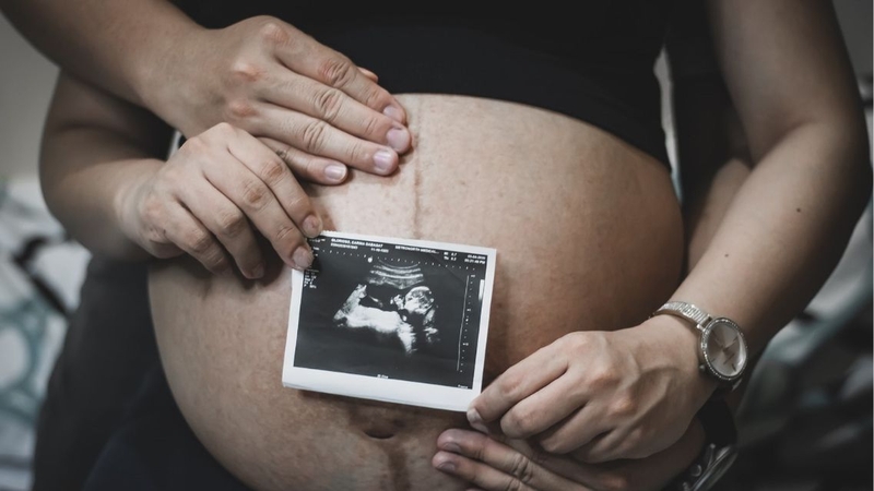 Teo cơ tủy sống (SMA) là bệnh thần kinh cơ có liên quan đến bất thường di truyền