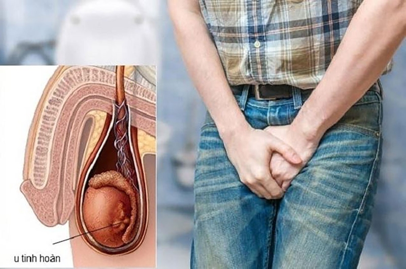 Teo một bên tinh hoàn có sinh con được không - 2