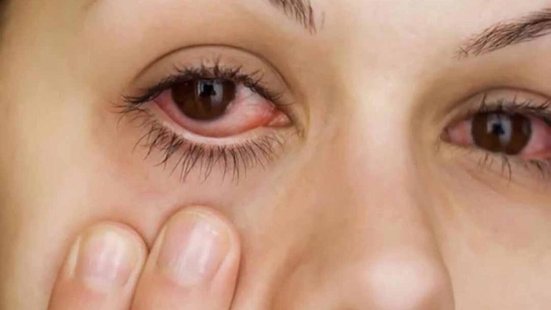 Teo nhãn cầu bẩm sinh: Nguyên nhân, triệu chứng và phương pháp điều trị 2