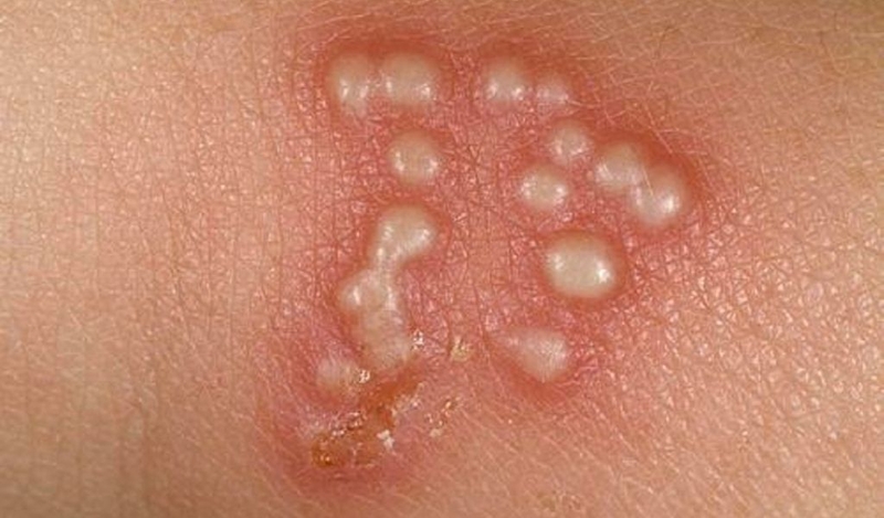 Test nhanh giang mai có chính xác không? 1