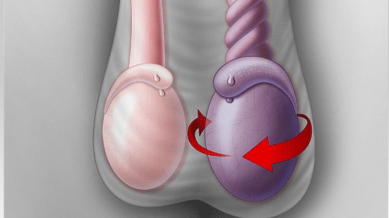 Xoắn tinh hoàn là tình trạng tinh hoàn xoắn quanh trục 1