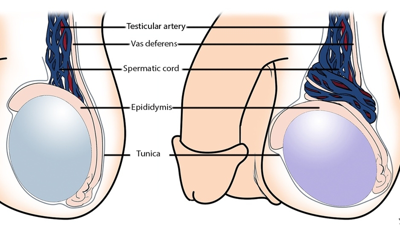 Tinh hoàn nằm ngang là một yếu tố làm tăng nguy cơ xoắn tinh hoàn 2
