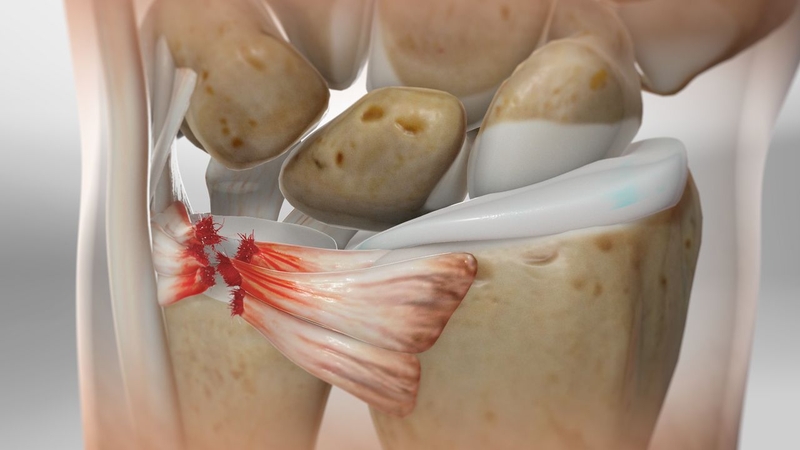 TFCC là gì? Tổn thương TFCC gây ra những triệu chứng nào? 1