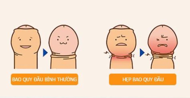 Thắc mắc: 17 tuổi chưa lột bao quy đầu có sao không? 2