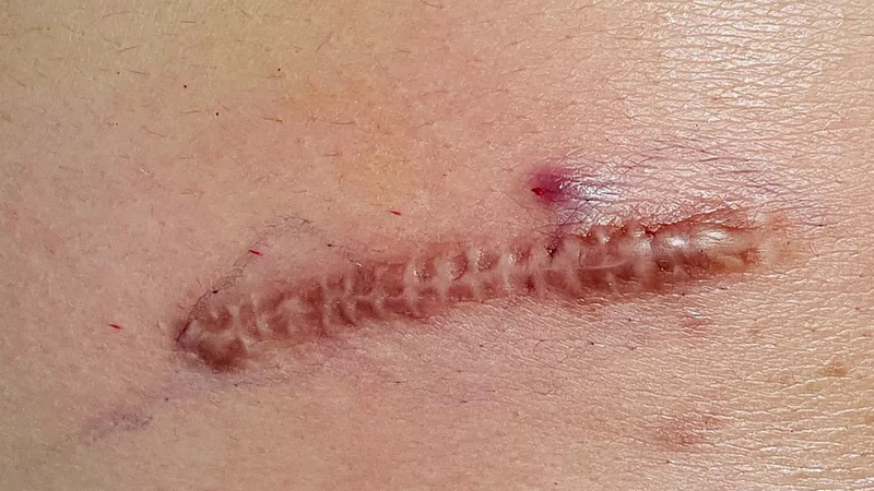 Thắc mắc: Ăn gì để không bị sẹo? 1