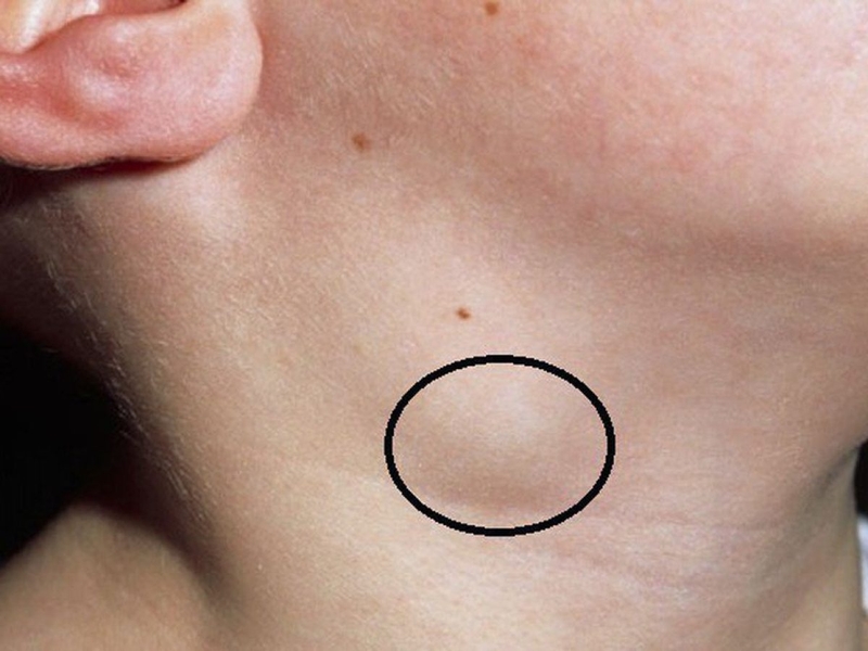 Thắc mắc: Bệnh lao hạch có lây không 1