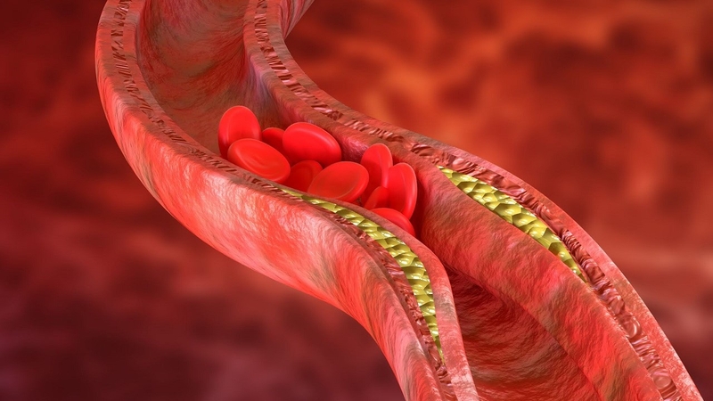 Thắc mắc: Bị thiếu máu cơ tim có chữa được không? 1