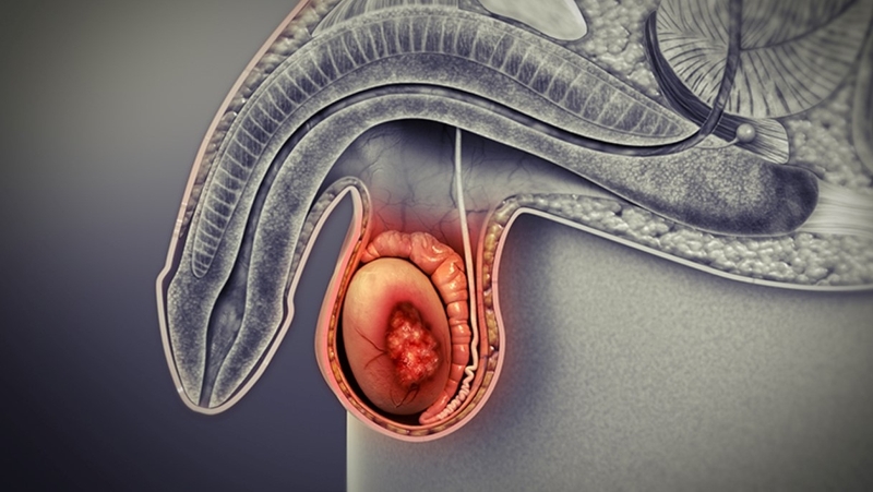 Bị viêm tinh hoàn cần được điều trị đúng cách