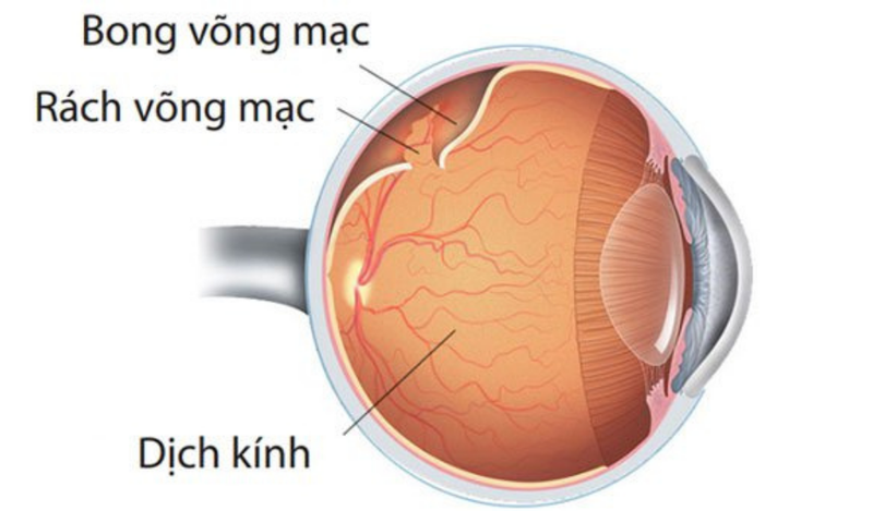 Bong võng mạc là gì?