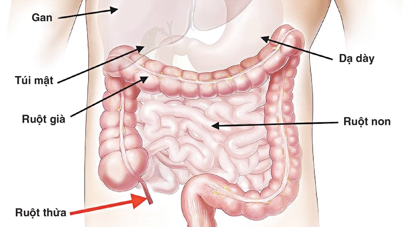 Thắc mắc: Chi phí mổ ruột thừa bao nhiêu tiền? 1