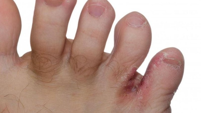 Thắc mắc: Hà ăn chân là bệnh gì? Làm sao chữa trị? 1