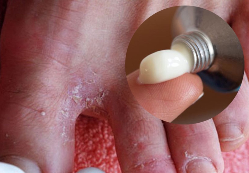 Thắc mắc: Hà ăn chân là bệnh gì? Làm sao chữa trị? 4