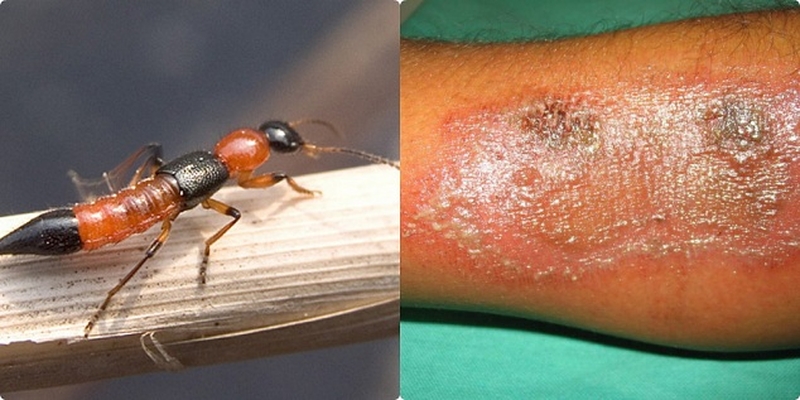 Thắc mắc: Kiến ba khoang đốt có để lại sẹo không?