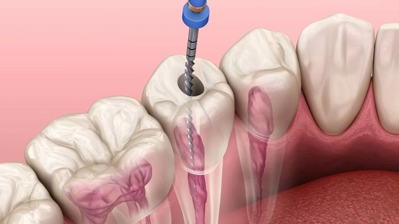 Thắc mắc lấy tủy răng có tiêm thuốc tê không 1