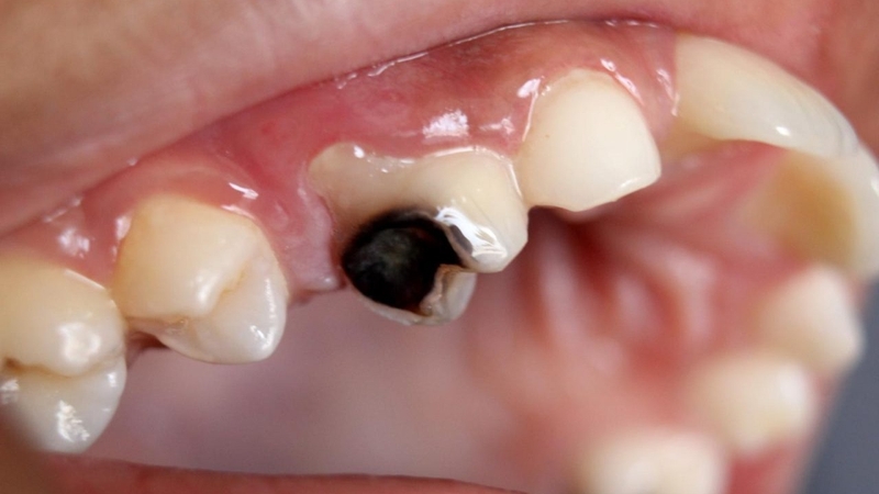 Thắc mắc lấy tủy răng có tiêm thuốc tê không 3