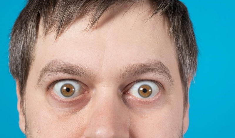 Thắc mắc: Mắt lồi có nên đeo lens?1