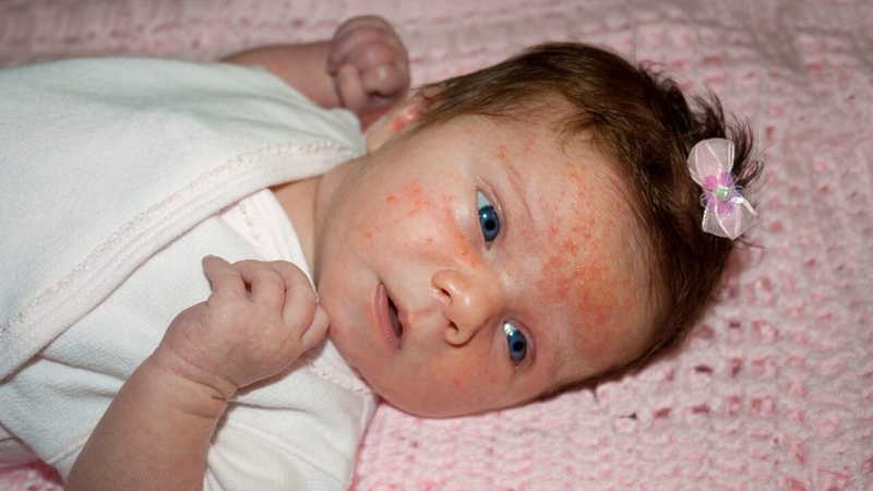 Thắc mắc mụn sữa ở trẻ sơ sinh bôi thuốc gì nhanh khỏi 2