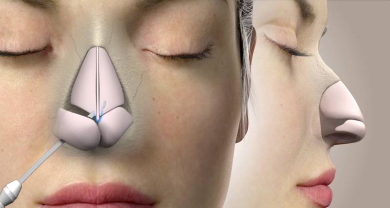 Thắc mắc: Nâng mũi rồi có tiêm filler được không?1