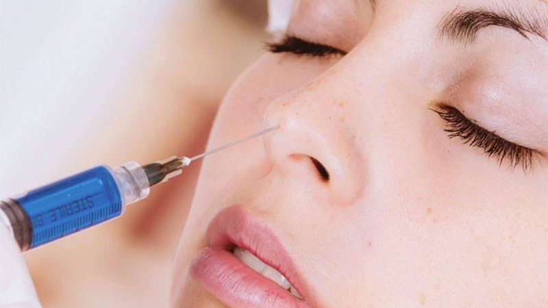 Thắc mắc: Nâng mũi rồi có tiêm filler được không?4