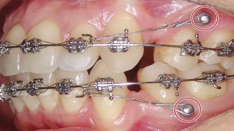 Thắc mắc niềng răng bao lâu thì thay dây cung 4