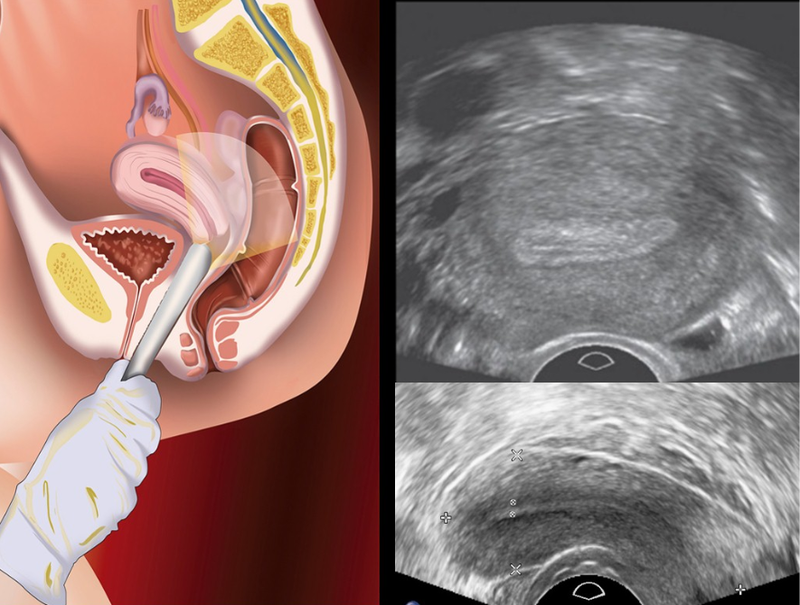 Thắc mắc: Siêu âm có phát hiện viêm vùng chậu không? 6