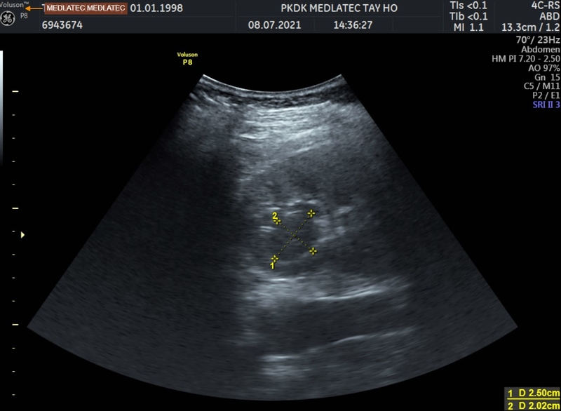 Thắc mắc: Siêu âm có phát hiện viêm vùng chậu không? 7