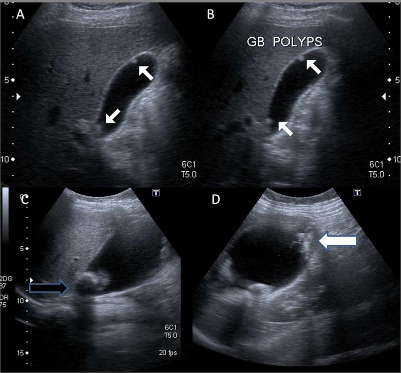 Thắc mắc: Siêu âm túi mật phát hiện bệnh gì? Siêu âm túi mật có phải nhịn ăn không? 3