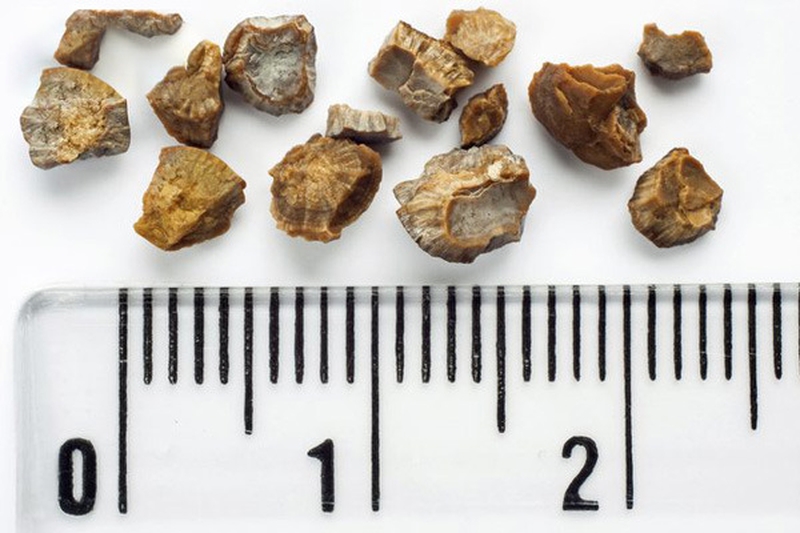 thắc mắc sỏi mật có kích thước bao nhiêu phải mổ 1