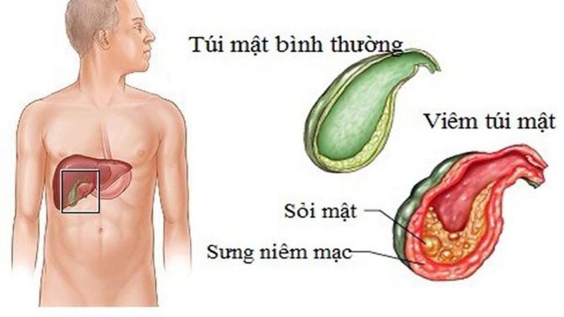 thắc mắc sỏi mật có kích thước bao nhiêu phải mổ 3