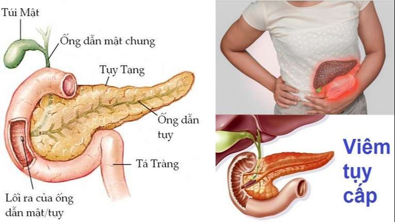 thắc mắc tại sao sỏi mật gây viêm tụy cấp 1