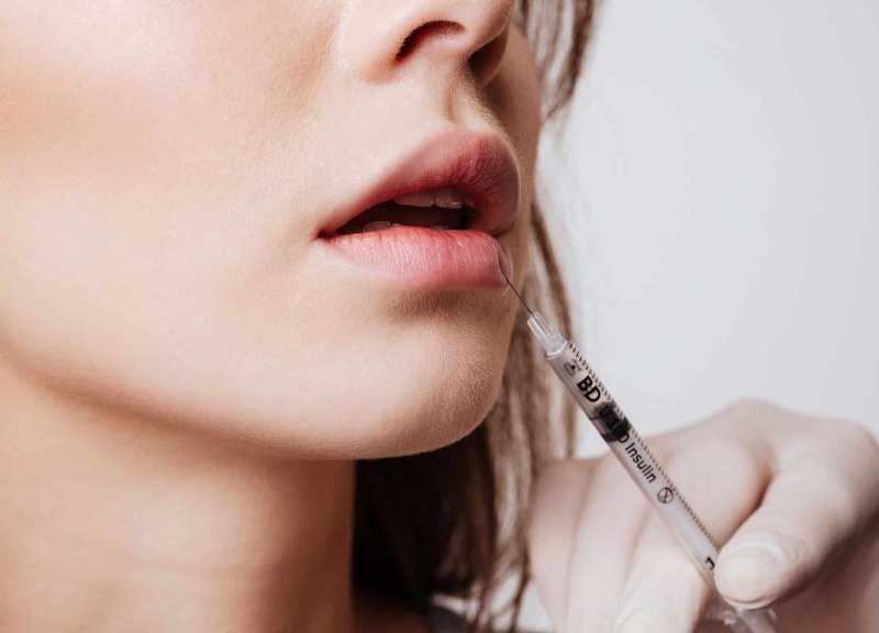 Thắc mắc: Tiêm filler da có bị chảy xệ không?3