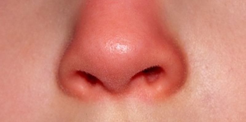 Thắc mắc: Tiêm filler mũi bị đỏ có sao không?1