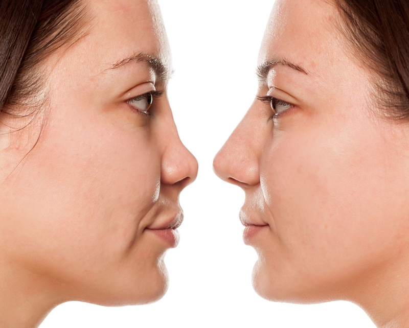 Thắc mắc: Tiêm filler mũi bị tràn có nguy hiểm không?2