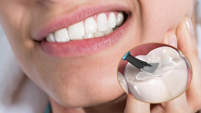 Thắc mắc: Trám răng có đau không? 5