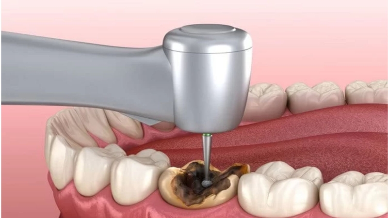 Thắc mắc: Trám răng là gì? Khi nào cần phải trám răng? 4