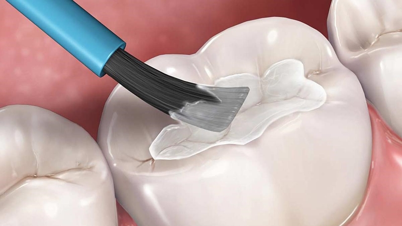 Thắc mắc: Trám răng là gì? Khi nào cần phải trám răng? 6