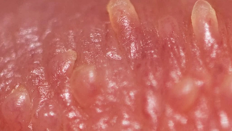 Thắc mắc: U nhú gai sinh dục là gì? Có nguy hiểm không? 1