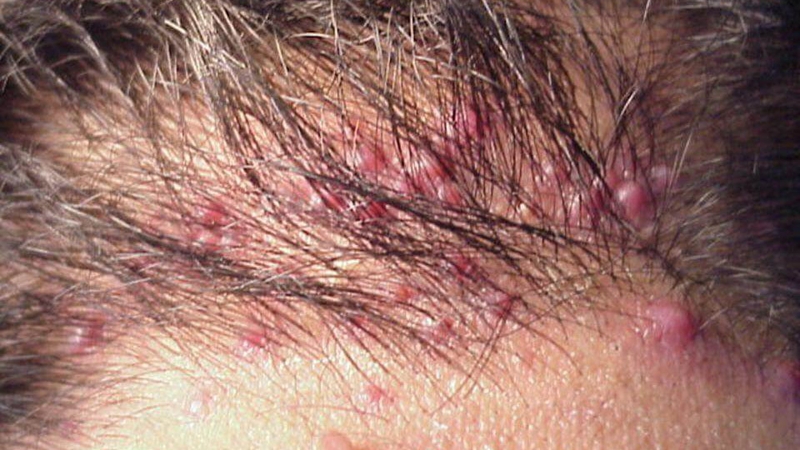 Thắc mắc: Viêm da đầu có mủ do đâu? Hướng dẫn cách trị viêm da đầu có mủ an toàn từ gốc 1
