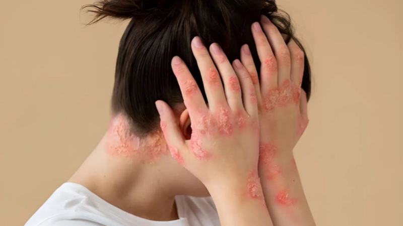 Thách thức trong chẩn đoán và điều trị viêm khớp vẩy nến 3