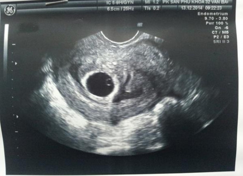 Thai 7 tuần có yolksac chưa có phôi thai là do đâu? 1