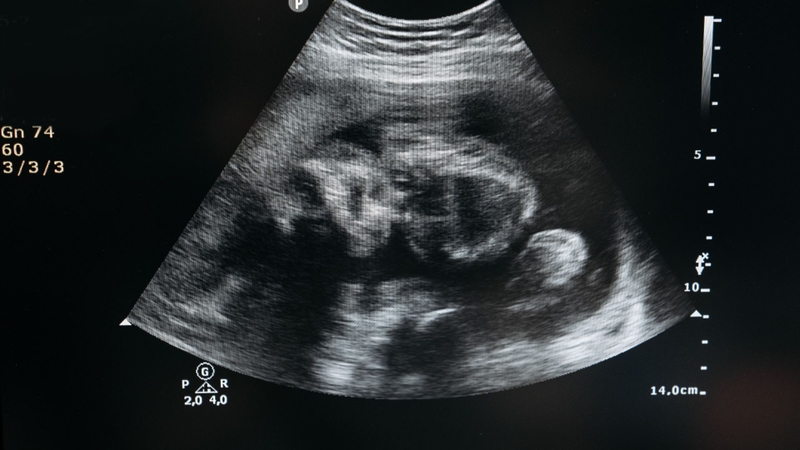 Thai 18 tuần: Sự phát triển của thai nhi cùng với sự thay đổi của mẹ bầu 3