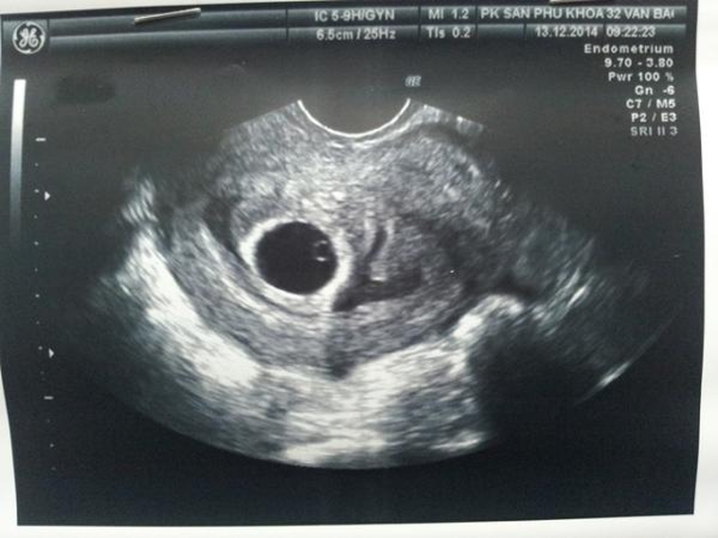 Giải đáp thắc mắc: Thai mấy tuần thì có tim thai? 1