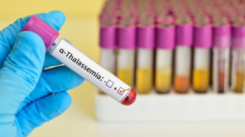 Căn bệnh di truyền điển hình nhất là bệnh tan máu bẩm sinh Thalassemia thể alpha