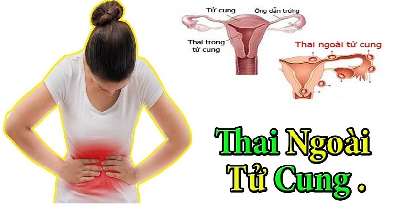 Thai ngoài tử cung siêu âm có thấy không và những lưu ý 1
