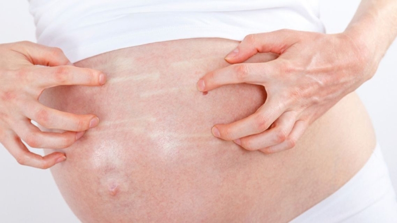 Ngứa bụng khi mang thai có thể liên quan đến sự căng giãn của da