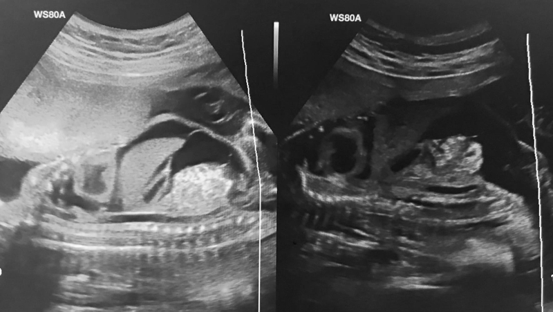 Thai phụ bị hội chứng hygroma kystique nguy hiểm ra sao?  2