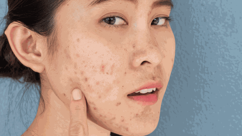 Thâm mụn nên dùng gì? Nguyên nhân và cách khắc phục hiệu quả 1